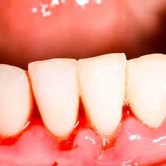 Why Do My Gums Bleed On Brushing? Why Do My Gums Bleed On Brushing?