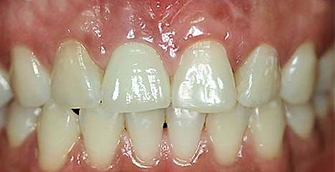 crown after implant