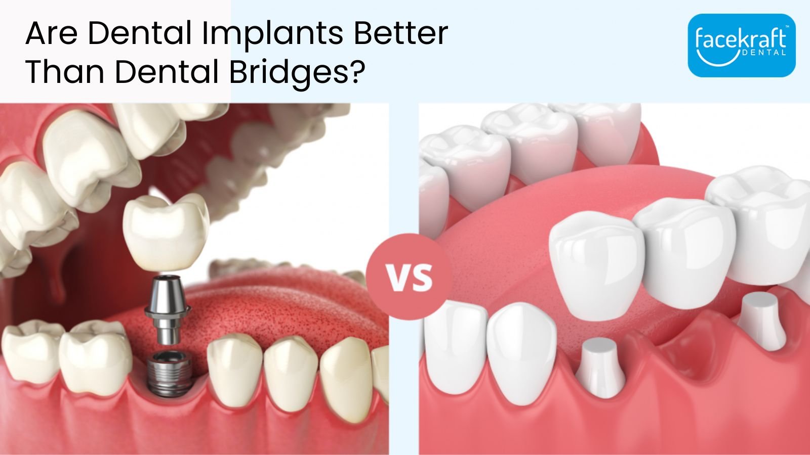 Dental Bridges Vs Implants